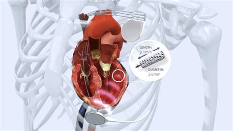 lv endocardial pacing